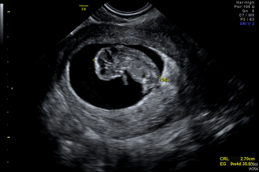 Ultrasonido durante el embarazo – Grupo CT Scanner