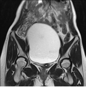 La resonancia magnética en lesiones ováricas Grupo CT Scanner