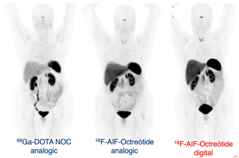 Utilidad del PET/CT Digital – Grupo CT Scanner