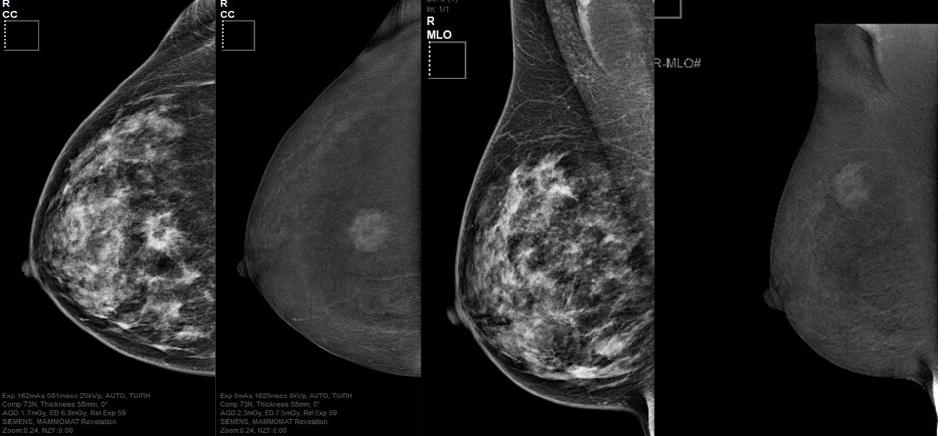 Casos clínicos de la Unidad de Imagen Mamaria – Grupo CT Scanner