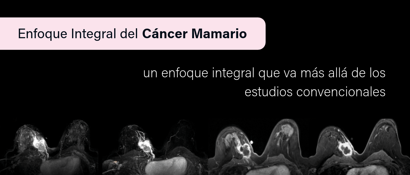 Enfoque Integral del Cáncer Mamario