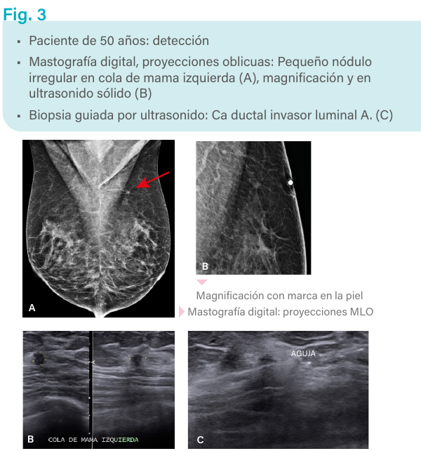 Figura 3. Ultrasonido y biopsia guiada.