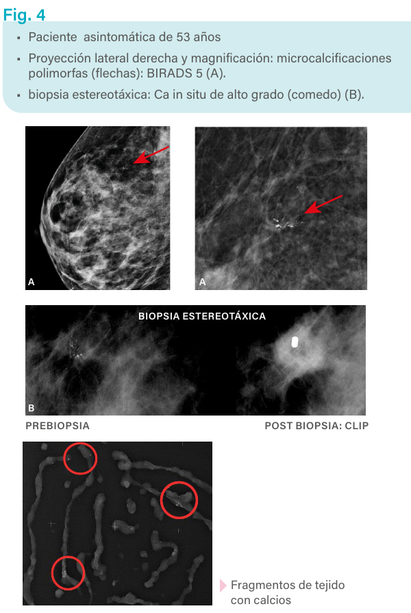 Figura 4. Biopsia estereotáxica.