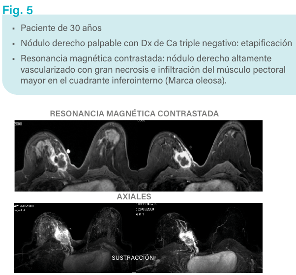 Figura 5. Resonancia magnética contrastada.